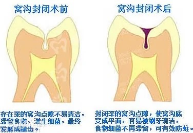 窝沟封闭3格式修改后.jpg